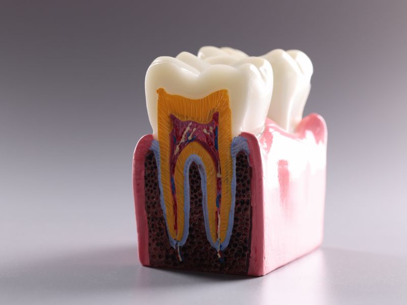 Root Canals