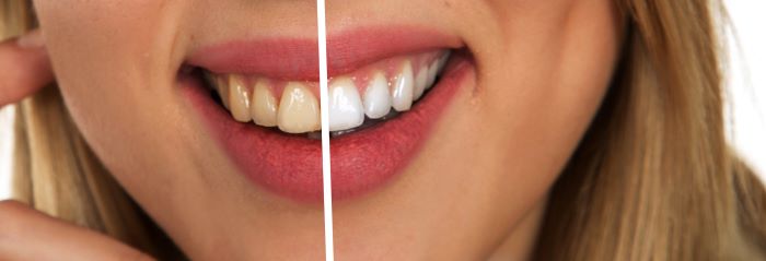 Professional Teeth Whitening