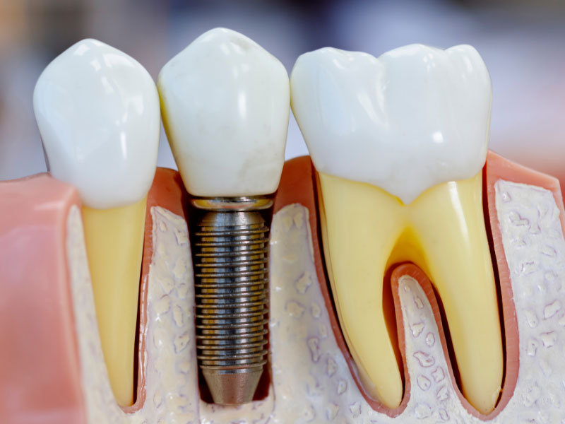 Dental Implants