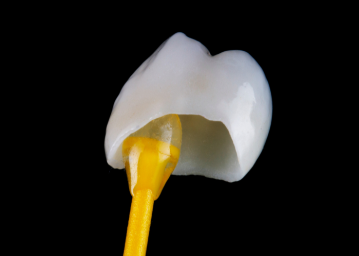 Dental Crown Boise
