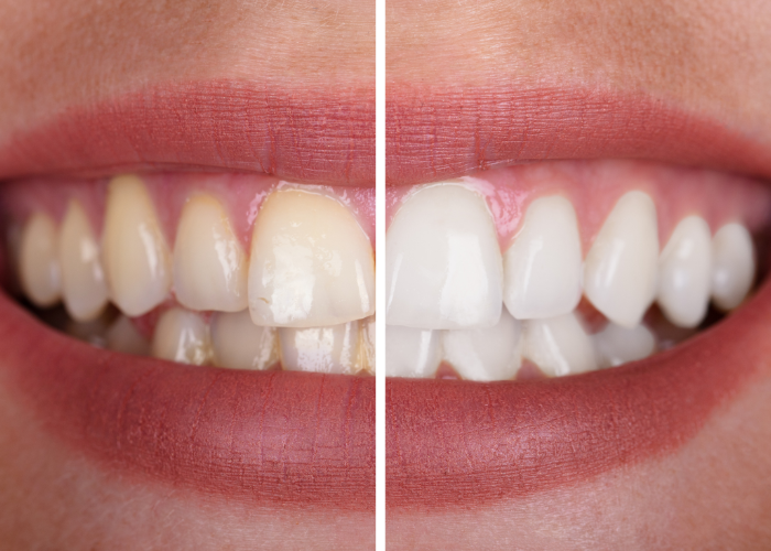 Teeth Whitening Boise